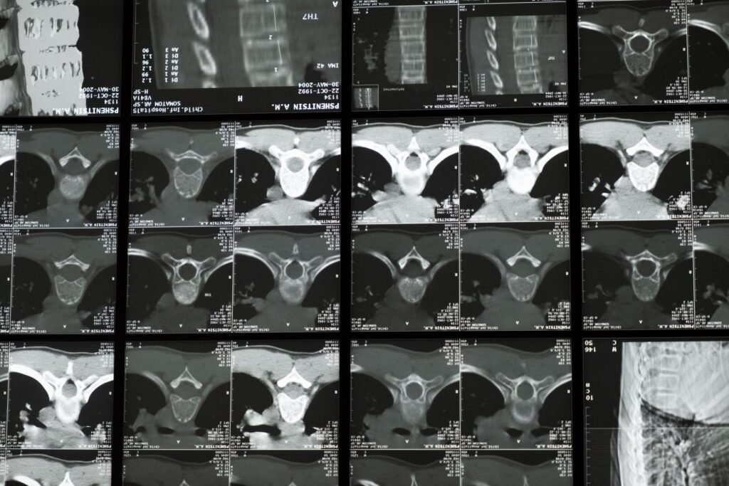 Radiology images of the spine on a screen, representing treatment costs where a cashless claim was only partly approved