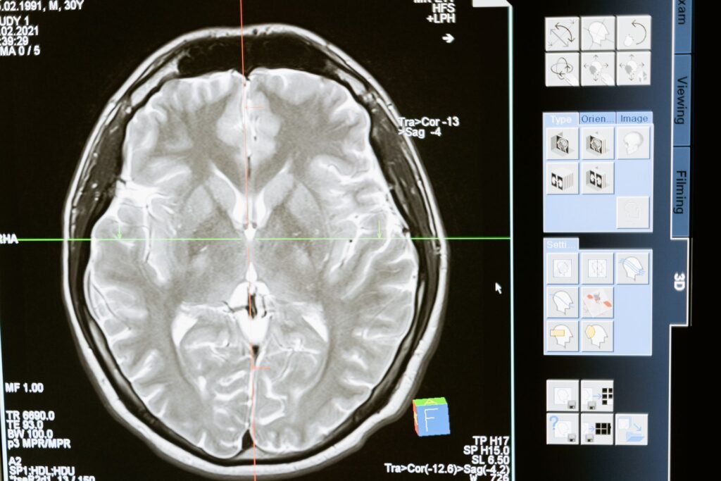 MRI brain scan displayed on a computer screen, representing medical reports organised and shared with Delhi hospitals before travel