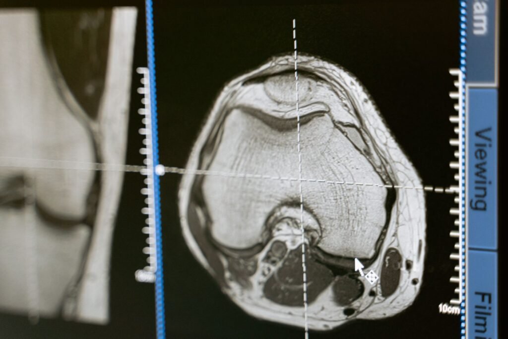 MRI scan displayed on a medical monitor, representing the reports and scans shared with Mumbai hospitals before a patient travels