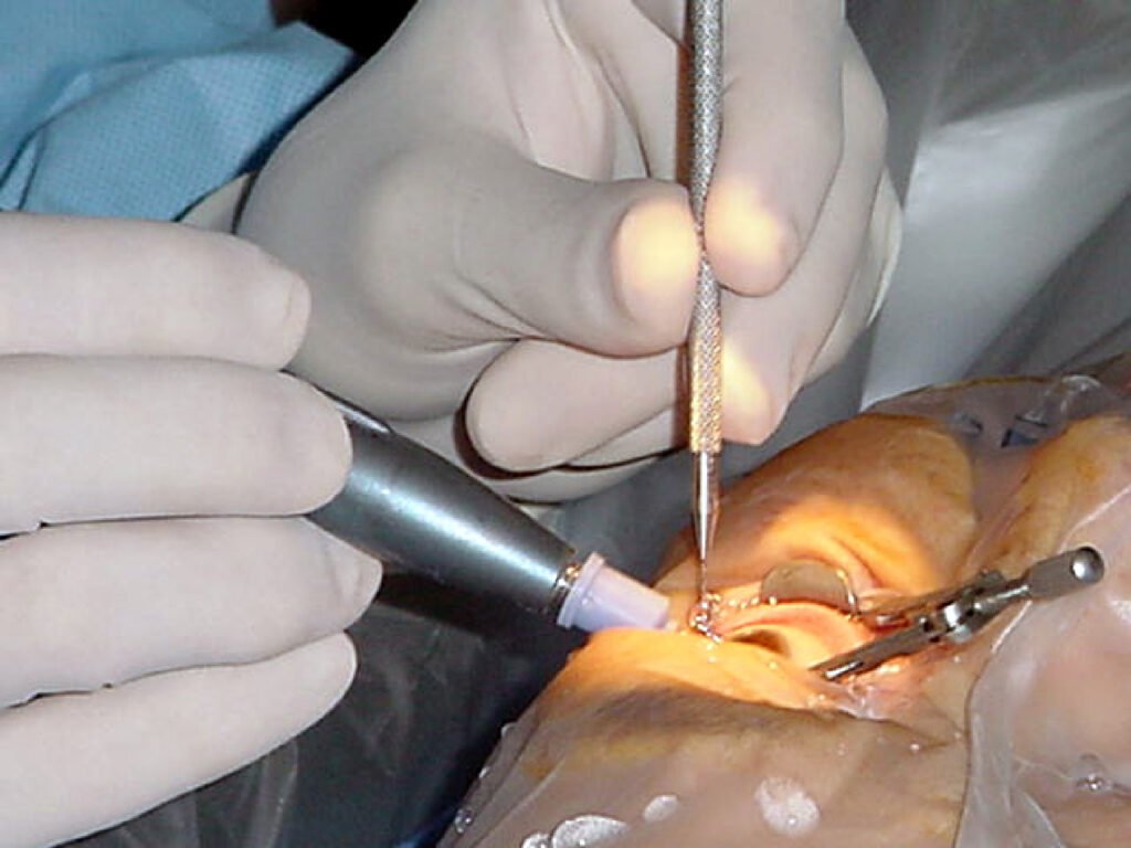 Surgeon performing cataract surgery under an operating microscope